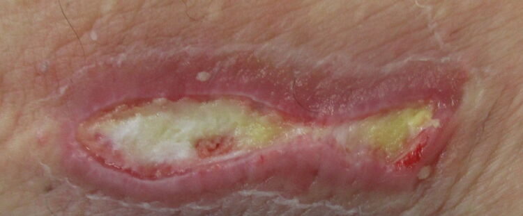 Behçet Syndrom (BS) Bild nach konservativer THerapie