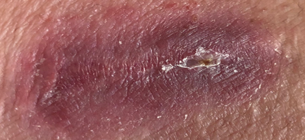 Behçet Syndrom (BS) Bild 1 Woche nach 1 Spritze Adalimumab